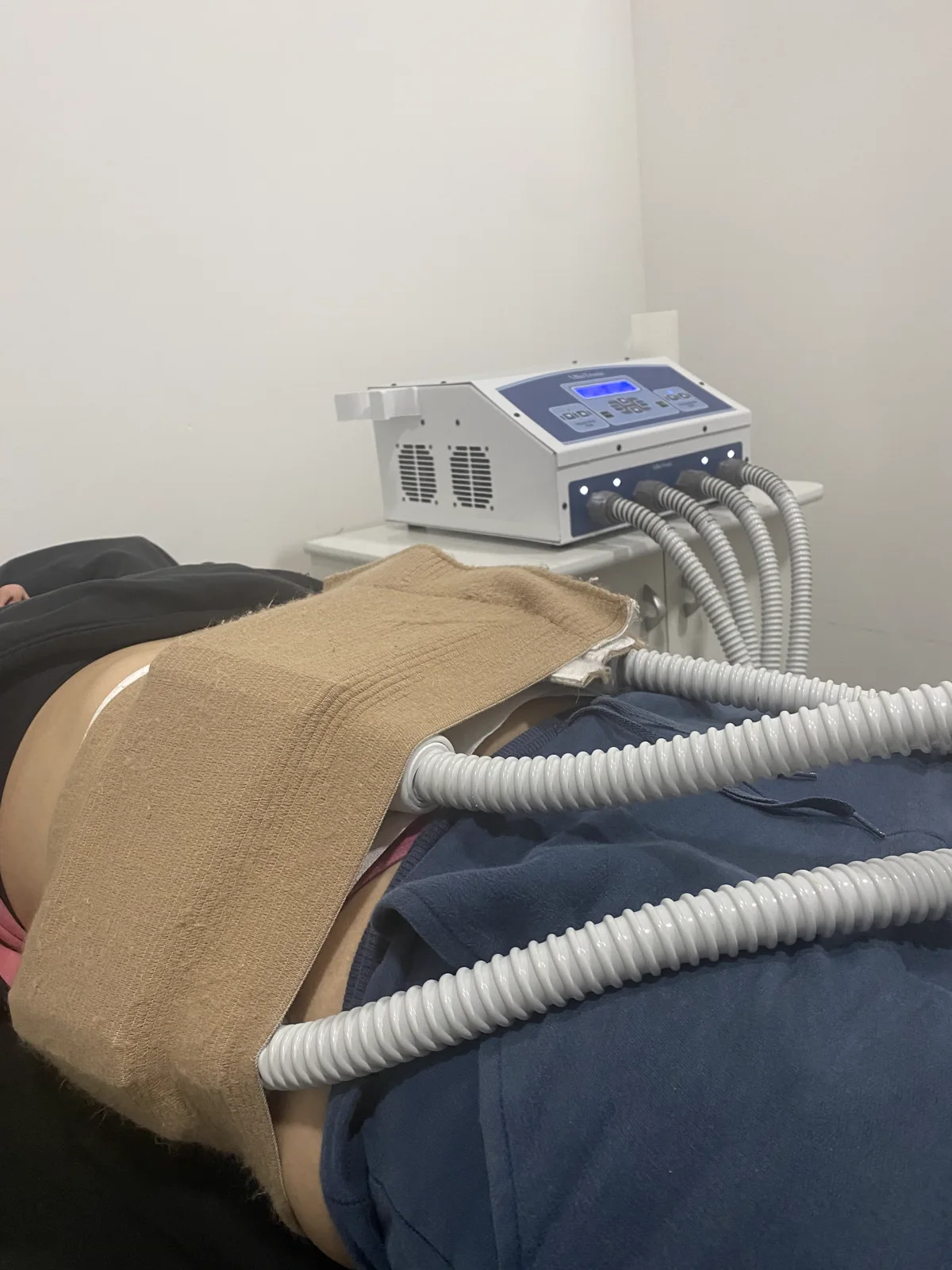 Sesión de Criolipólisis en Antoá: el aplicador plano de frío trabaja sobre el abdomen de la clienta junto a la consola del equipo